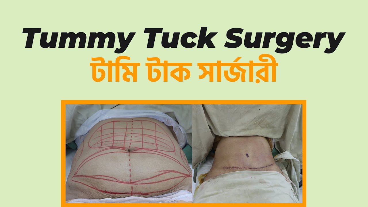 Tummy Tuck Surgery। টামি টাক সার্জারী। Dr Sharif Plastic Surgeon