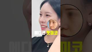 코성형 보형물 부담? 핏미코로 줄이세요 #비포애프터 #shorts #코수술후기