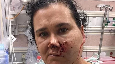 Arkansas Woman SHOT IN THE FACE With CROSSBOW...Su...
