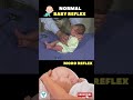 Normal Baby Reflex 😳 Moro reflex | Baby movement ✅ #shortsvideo #baby #health #kids