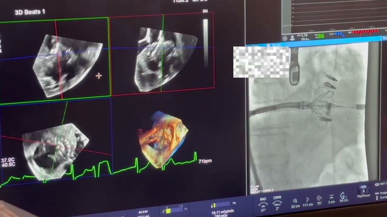 Evoque tricuspid valve placement with electrocautery of existing tricuspid valve clip.