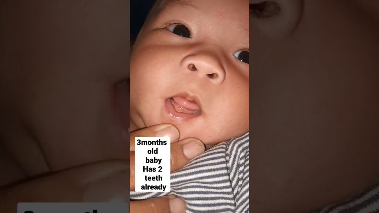 3 months old baby has 2 teeth Already 