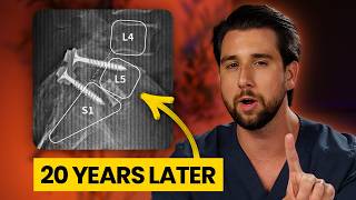 My Dad’s Back Hurts 20 Years After Spinal Fusion — Here’s Why