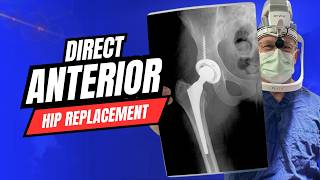 Hip Replacement Surgery Reimagined | Anterior Approach Technique