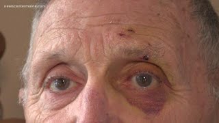 88-year-old man fights fox with bare hands