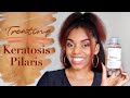 Treating Keratosis Pilaris || Glow Like a Goddess