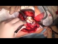 Partial nephrectomy (open - 3 cases)/ Открытая резекция почки (3 операции)