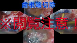 上顎左側第一大臼歯の歯根端切除Maxilla left first molar Apicoectomy(Medial buccal root canal)