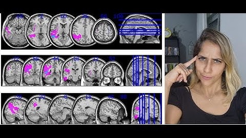 A quick guide to create MRI overlap lesion maps using MRIcron