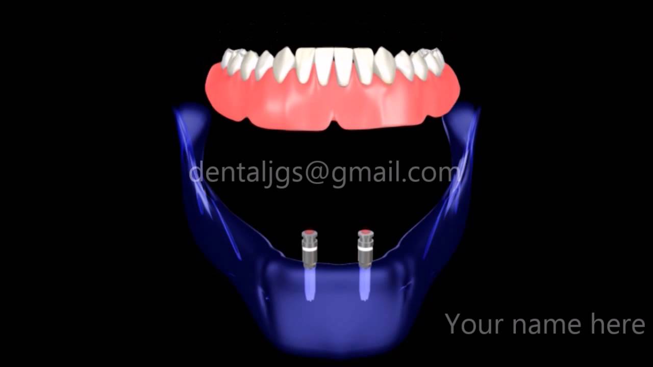 Removable Dental Implants - Artistic Dentistry