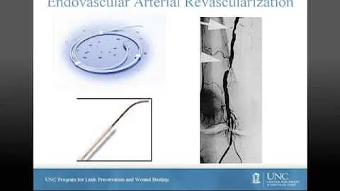 Dr. Marston presents a program for for limb preservation and wound healing