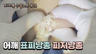 수술노트 #16 어깨 피지낭종 표피낭종 계속 나오는 피지~