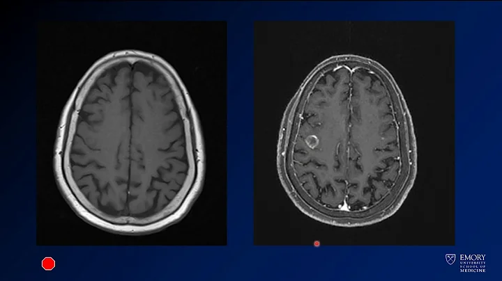 Imaging intracranial hemorrhage - Case 2 - Metastases
