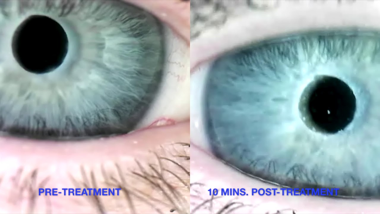 Dry Eye Patient with Sjogren's Syndrome Wearing Bandage Contact Lenses