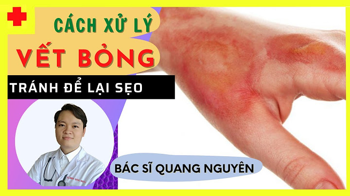 Hướng dẫn chữa bị bỏng bởi bọc cháy năm 2024