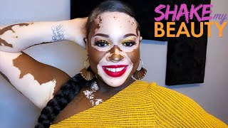 I Hid My Vitiligo For 12 Years - But Not Anymore | SHAKE MY BEAUTY