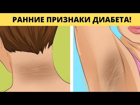 Не Игнорируйте Эти Ранние Признаки Сахарного Диабета! Многие даже не подозревают об этом!