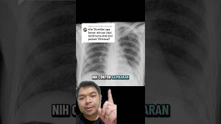 Kenalam Sama Tbc Milier