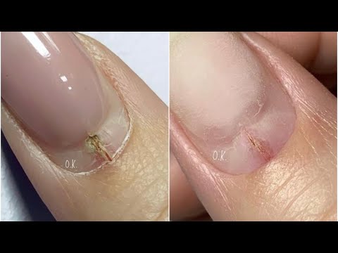 Травма ногтя | постепенное восстановление | 2 коррекции в одном видео