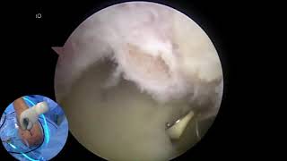 Arthroscopic Reduction Of A Chronic Locked Posterior Shoulder Dislocation