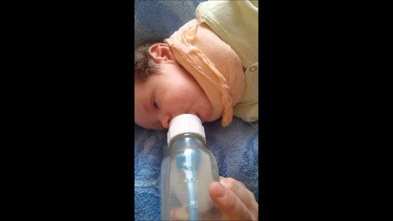 Синдром заходящего солнца (синдром Грефе).Пучеглазие. Гипертонус ручек. Отзывы о лечении.