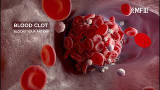 MF3 PlaqX – What is Atherosclerosis?