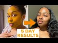 I DID A 5 DAY TURMERIC FACE MASK & This Happened!! || MISS C Beauty