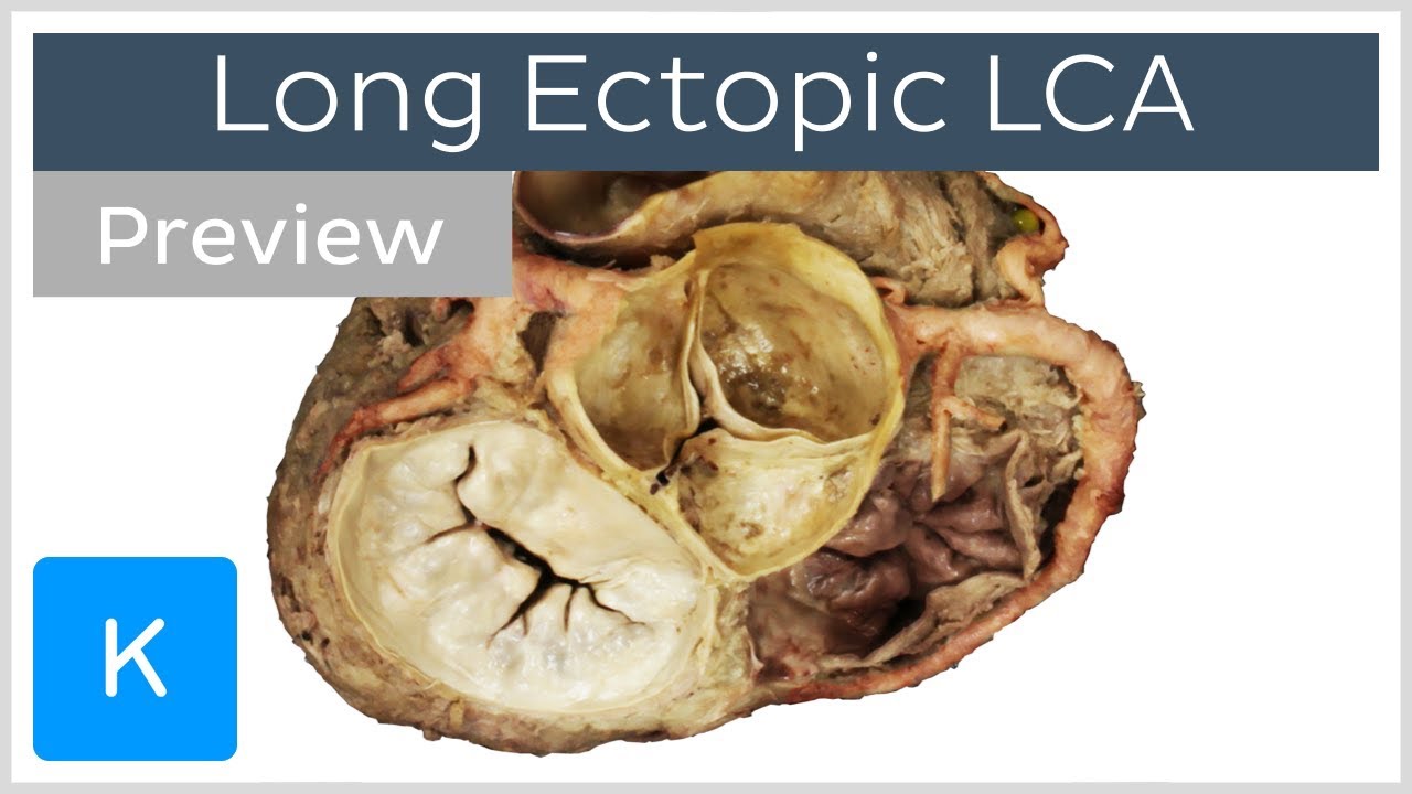 Long ectopic left main coronary artery (preview) - Clinical anatomy cases | Kenhub
