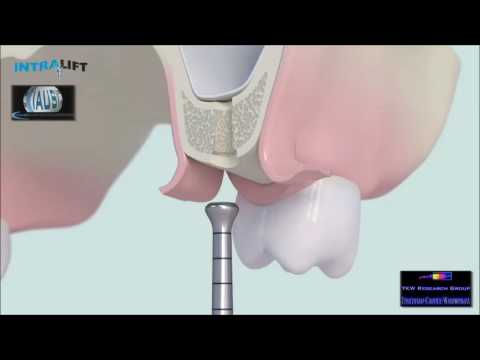 transcrestal Sinuslift INTRALIFT - surgical protocol