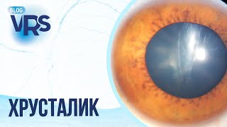 Травма глаза / Хрусталик