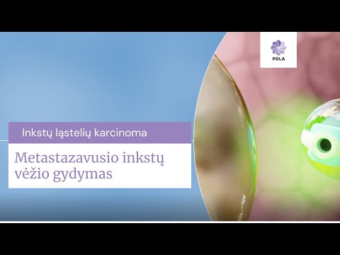 Metastazavusio inkstų vėžio gydymas