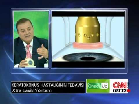 Keratokonus Hastalığının Tedavisinde