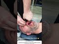Balloon Sinus Dilation DIY? Watch Before You Try 🎈👃
