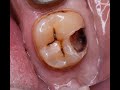 Реставрация жевательного  зуба