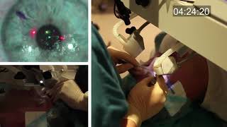 Real-time uncut unedited LASIK procedure live with real sound screenshot 1