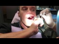 Taking Out My Own Wisdom Tooth!