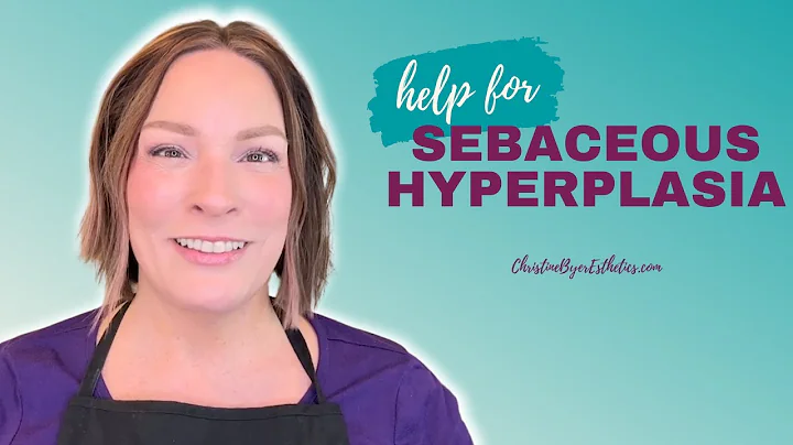Annoyed by Sebaceous Hyperplasia?