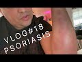 Vlog#18 - Naio Filming and Psoriasis Talk