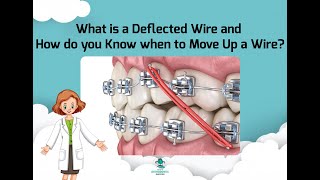 Wires Sequence- When to Change Wires. What is Wire Deflection?