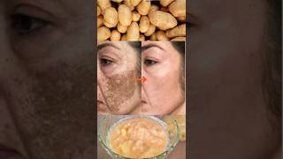 Potato Juice to remove skin pigmentation and dark spots ashortaday pigmentation potato