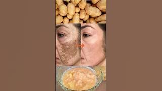 Potato Juice to remove skin pigmentation and dark spots #ashortaday #pigmentation #potato
