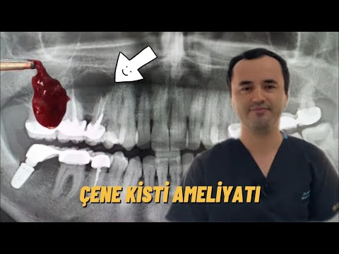 Kist Ameliyatı//Dental Cyst Removal Surgery