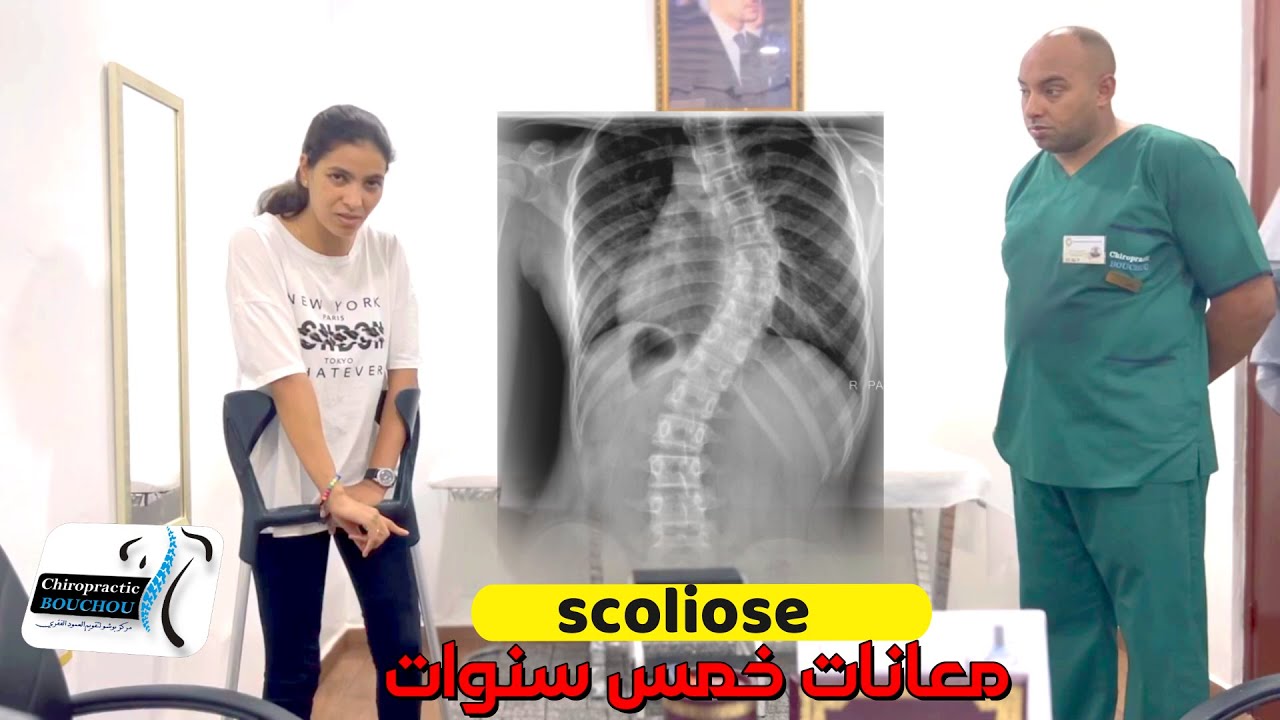 حالة سكوليوز (scoliose) عانت مدة 5 سنوات