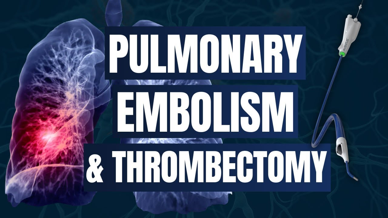 Pulmonary Embolism & Thrombectomy