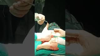 large Size of Appendix during interval appendicectomy located in Retroperitoneal,upto Hepatic flexor