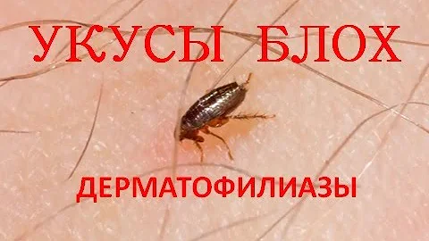 Блохи. Укусы блох (Дерматофилиазы)