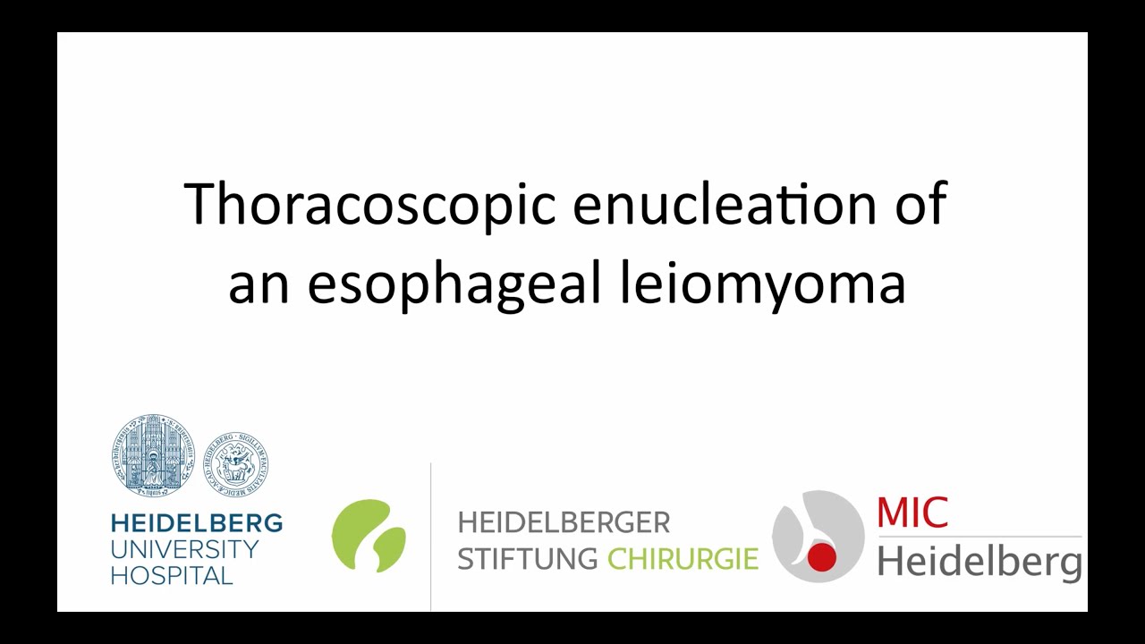 Thoracoscopic enucleation of an esophageal leiomyoma YouTube