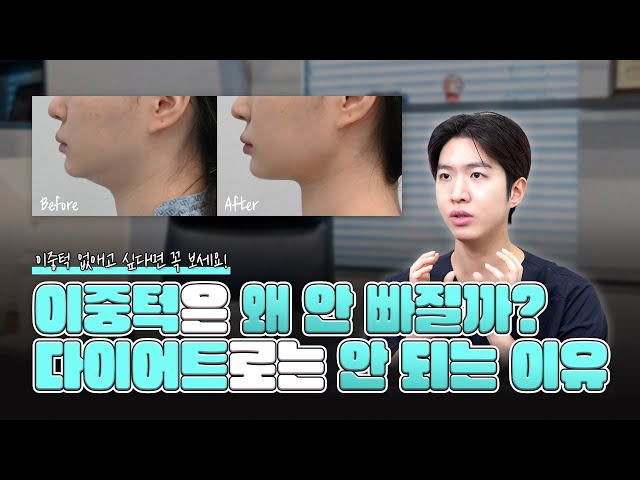 이중턱은 왜 안 빠질까? 다이어트로는 안 되는 이유