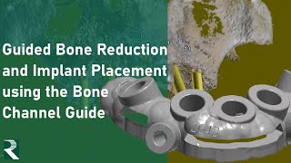 Guided Bone Reduction and Implant Placement Using the Bone Channel Guide