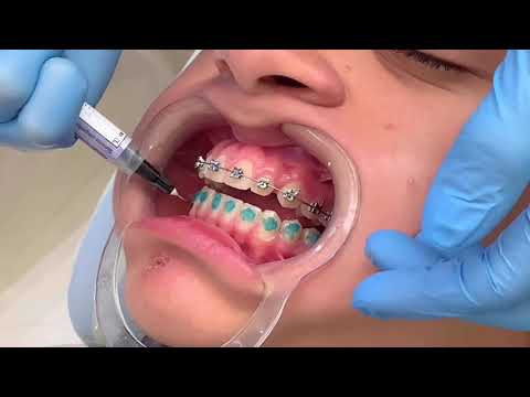 Vídeo: Como consertar uma coroa dentária ausente: 15 etapas